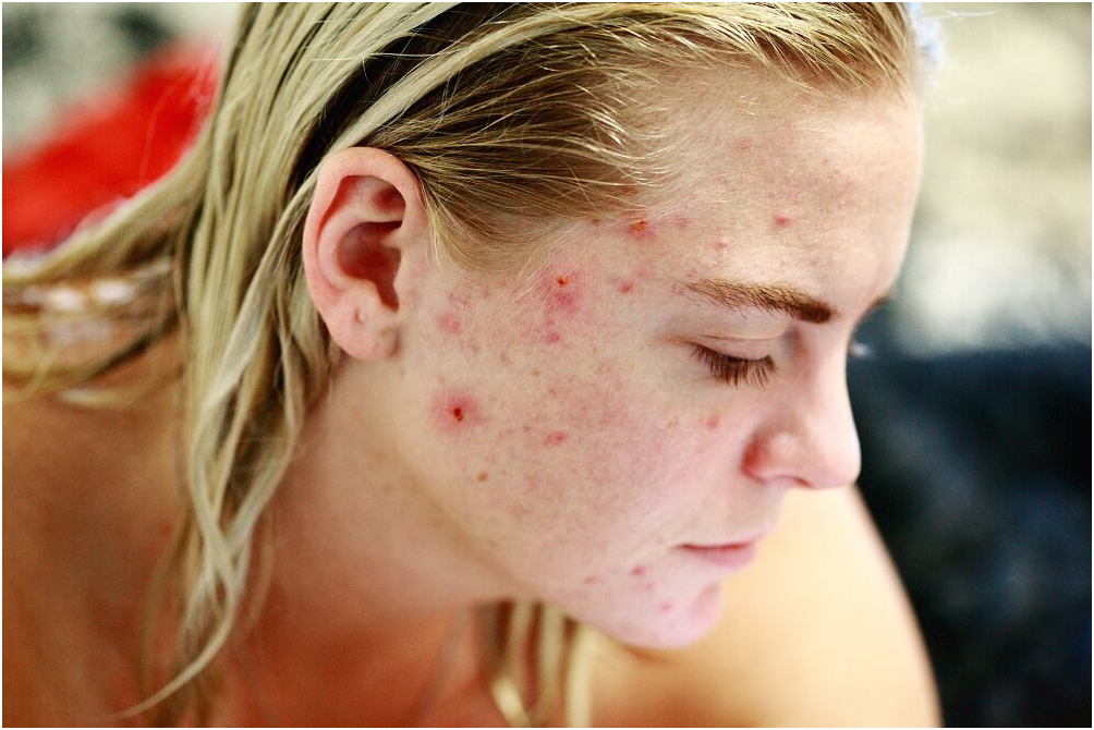 GUIDE TO TREATING ACNE SCARS AND SKIN DAMAGE