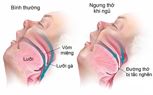 HỘI CHỨNG NGƯNG THỞ KHI NGỦ - SLEEP APNEA 